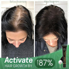 NextGrowâ„?Prevents bald spots | TODAY ONLY 1 + 1 FREE