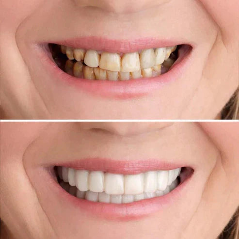 SmileFixâ„?Create the perfect teeth | ONLY TODAY 1 + 1 FREE