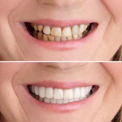 SmileFixâ„?Create the perfect teeth | ONLY TODAY 1 + 1 FREE