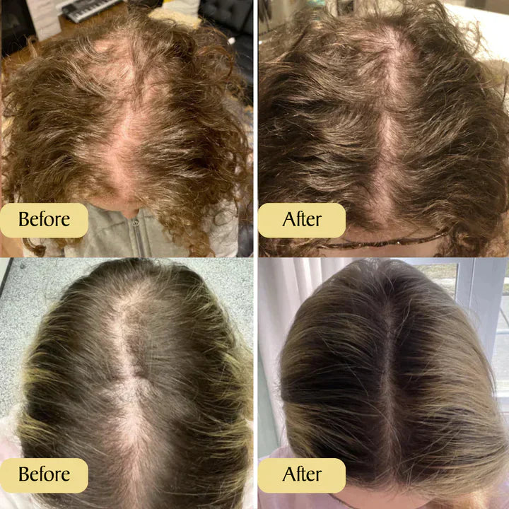 Carvenchyâ„?Prevention of Hair Loss | Temporarily 1+1 Free